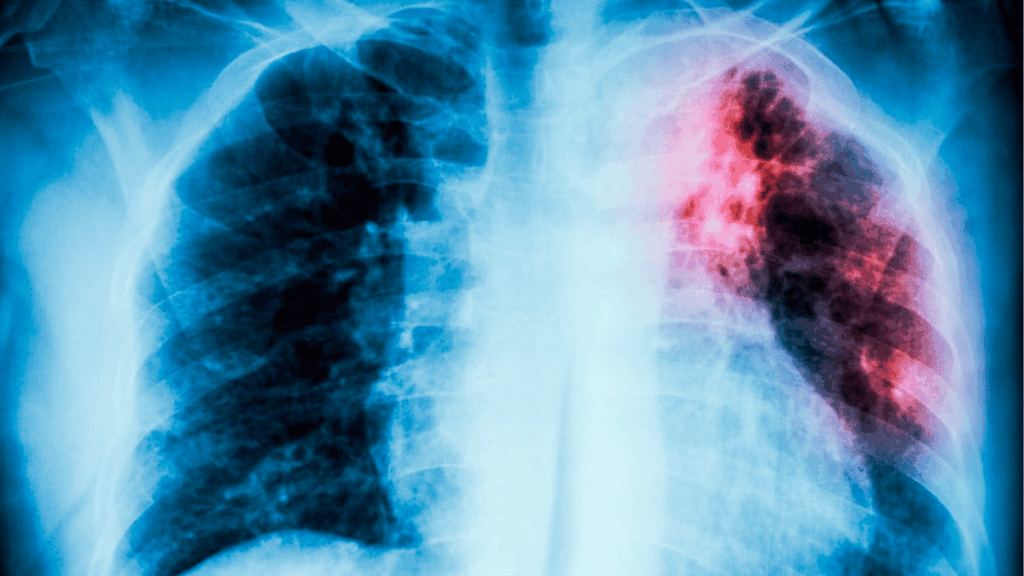 Infección Respiratoria - Tu Colonia Regia